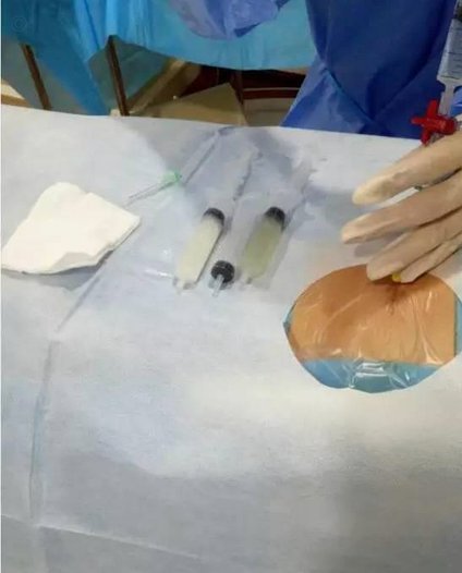 肾脏穿刺引流术：运动员需知的风险与影响