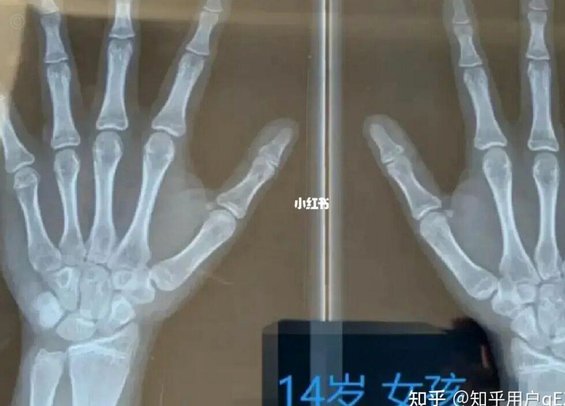 董路反对骨龄检测，误差成焦点